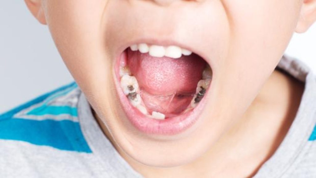 Caries presencia en niños