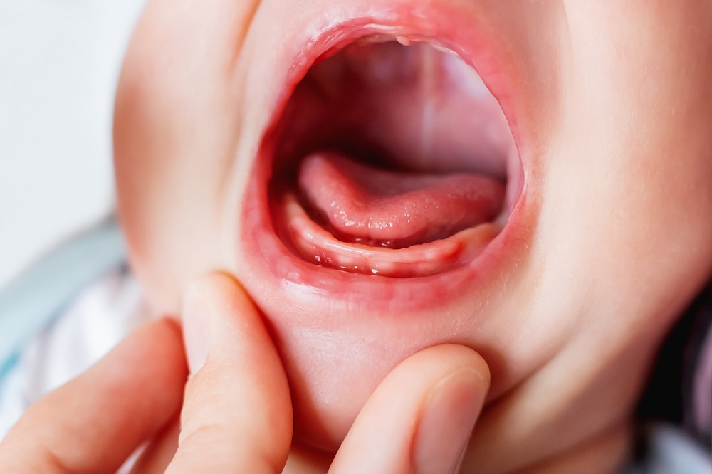 Cuidar las encías inflamadas en bebés