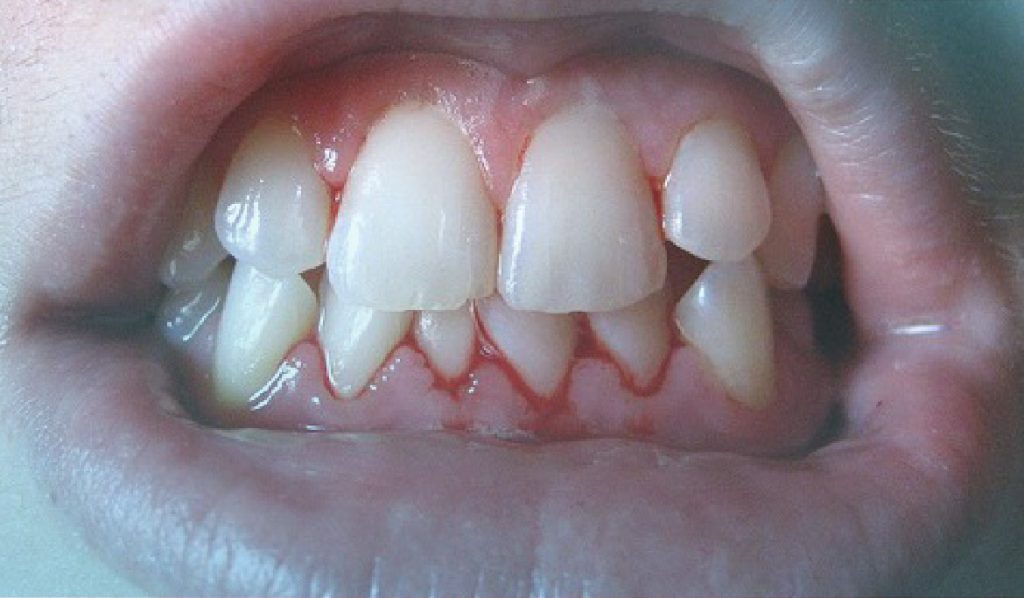 gingivitis infantil 1