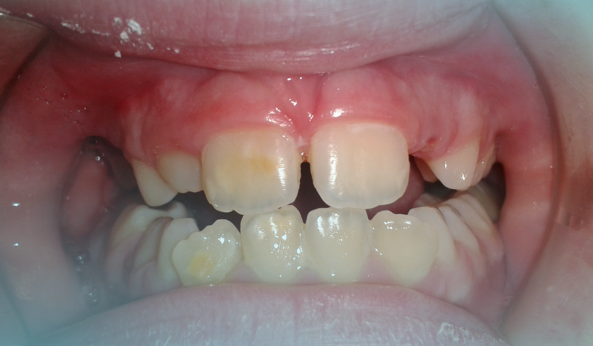 ¿Por qué les salen manchas en los dientes a los niños?