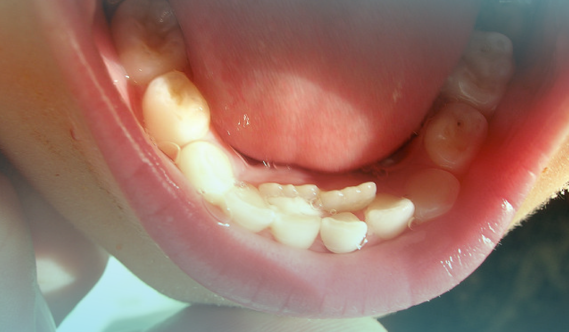 Los dientes de tiburón en la infancia