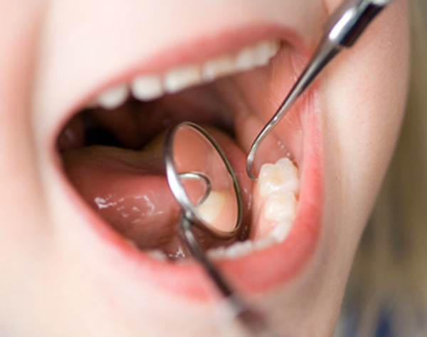 Selladores dentales en los niños