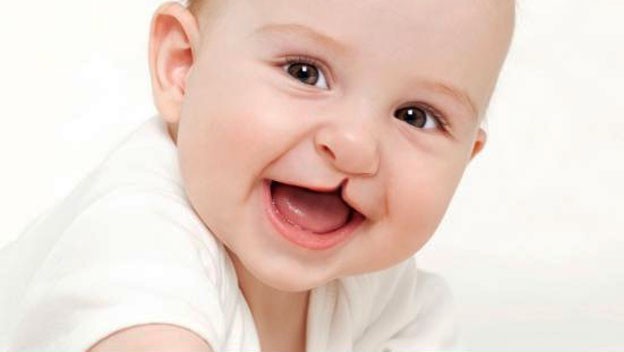 Cuidado dental: labio leporino y paladar hendido
