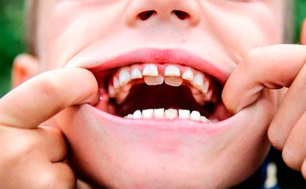 Dientes de tiburón en niños: ¿Qué son y cómo solucionarlo?