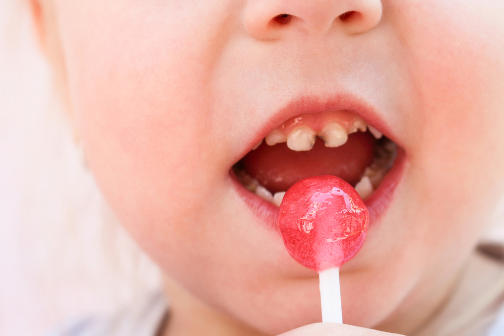 Dientes podridos en niños: tratamiento y prevención