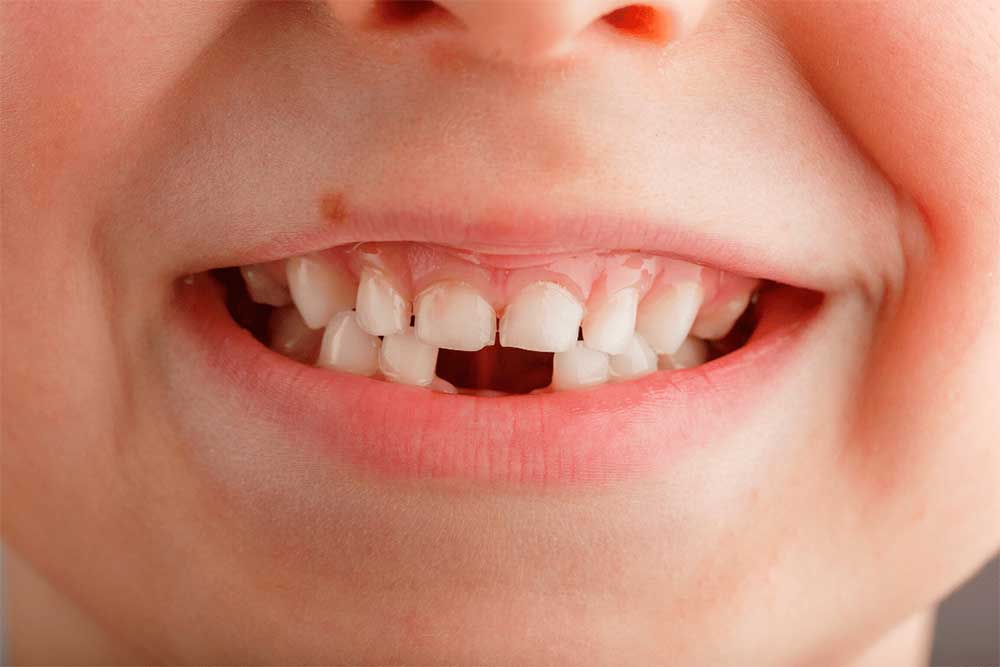 Agenesia dental en niños: tipos y tratamientos